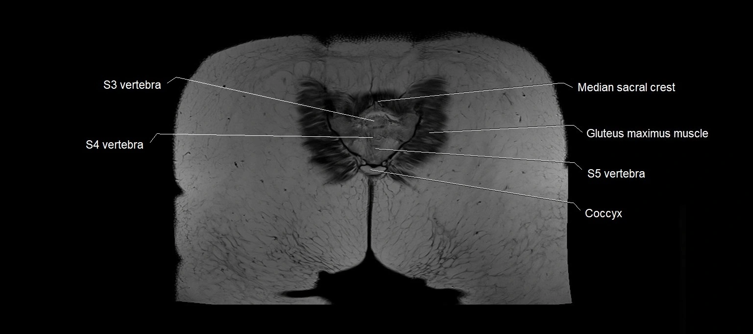 MRI 3T pelvis coronal cross section anatomy image 28.webp